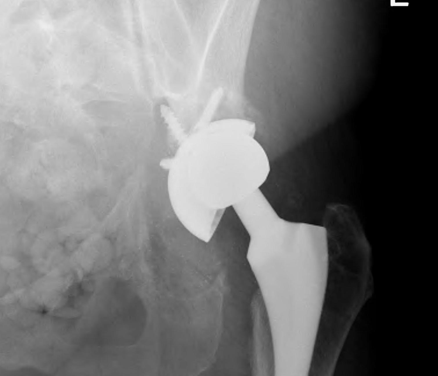 Revision THR Pelvic Discontinuity 2